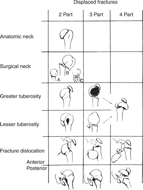 Proximal Humeral Fracture Classification