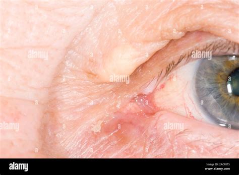 Xanthelasma Fatty Growth Called A Xanthoma Seen On The Upper Eyelid