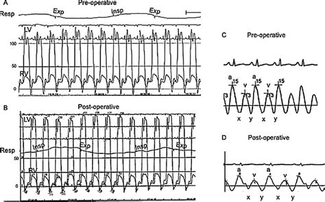 Pre And Post Operative The Rightleft Ventricular And Right Atrial