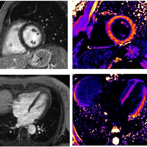 A 42-year-old woman presented as STEMI anterior localization SCAD on... | Download Scientific ...