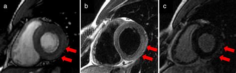 State Of The Art Evaluation And Prognostication Of Myocarditis Using