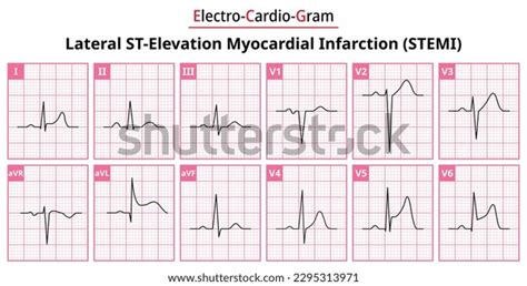 lateral stemi stelevation myocardial infarction differences stock