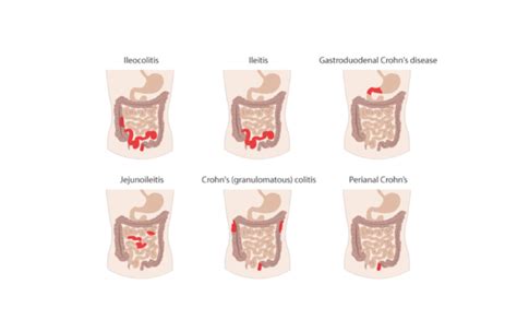 Ziekte Van Crohn IBD De Baas