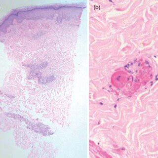 A Histology Revealed Small Blood Vessels With Luminal Fibrin Thrombi