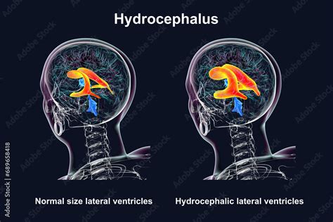 Enlarged and normal lateral ventricles, 3D illustration Stock ...