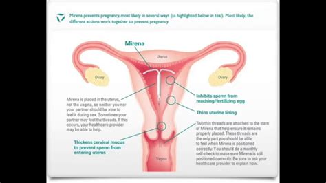 Iud Insertion And Symptoms Days 1 8 Youtube