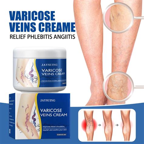 50g Varicose Veins Cream Varicose Vein Soothing Leg Cream Natural Varicose Spider Veins