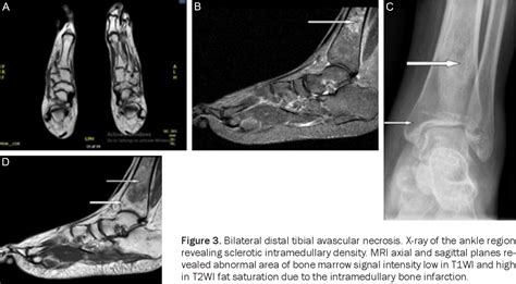 Figure From Rheumatological Picture Of A Patient Having Multifocal