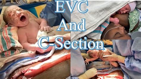 Live C Section After Failed EVC Breech Baby BREECH BABY Vlog