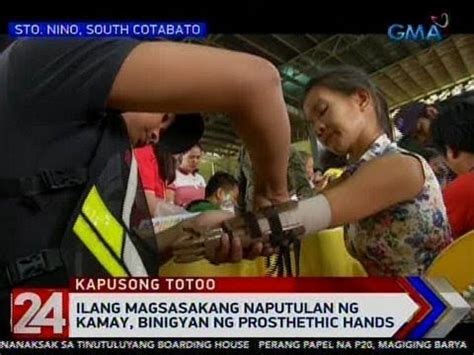 Ilang Magsasakang Naputulan Ng Kamay Binigyan Ng Prosthethic Hands