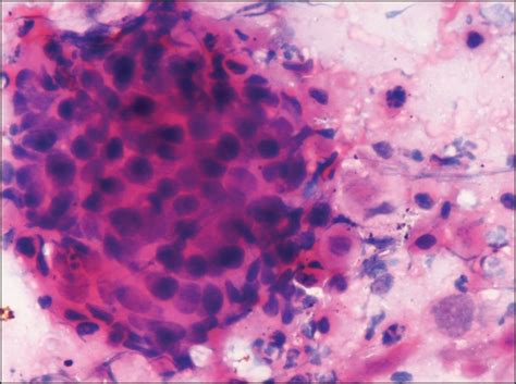 Poorly differentiated squamous cell carcinoma. Smear shows cohesive ...