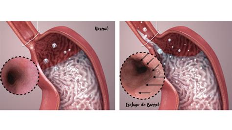 Aqui Como Curar EsôFago De Barrett Naturalmente úLtimo