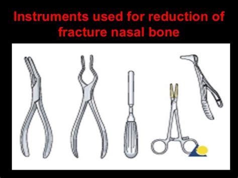 11 Facial Bone Fractures