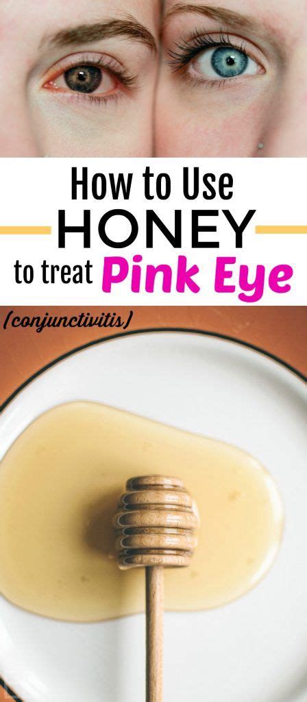 Honey For Pinkeye Conjunctivitis The Best Home Remedy Pink Eye