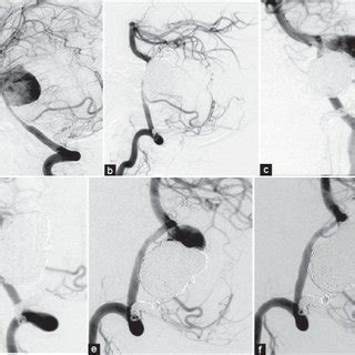 Right vertebral angiography demonstrates a giant vertebral artery ...