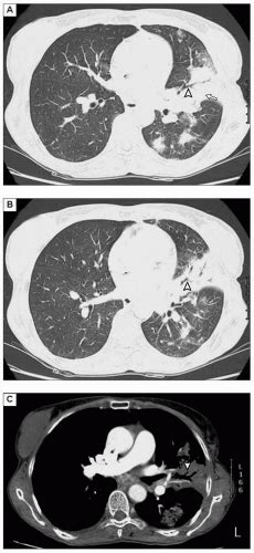 Community Acquired Pneumonia Thoracic Key