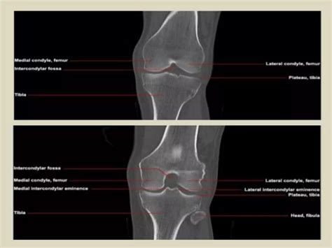 Presentation Pptx Radiological Anatomy Of The Knee Joint Ppt