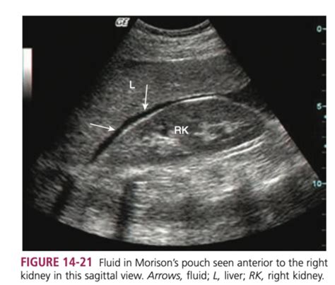 Cross Section Lecture 9 Peritoneum Retroperitoneum And Peritoneal