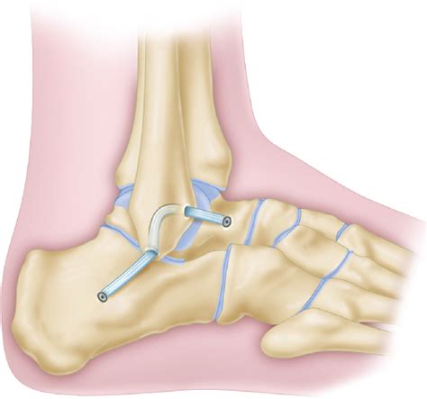 Anatomic Reconstruction Of Anterior Talofibular Ligament