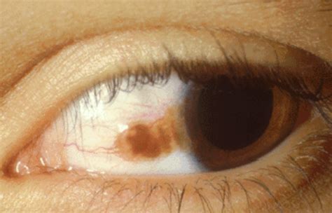 What Causes Brown Spots On Sclera Templates Printable Free