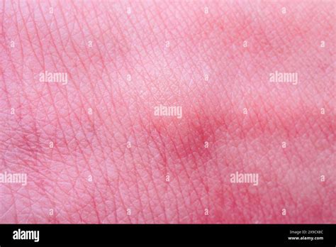 skin allergy with rash after mosquito bite Stock Photo - Alamy