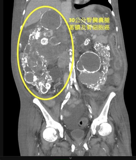 多囊腎癌變30公分腎細胞癌 腫瘤破裂出血引發敗血症 自由健康網