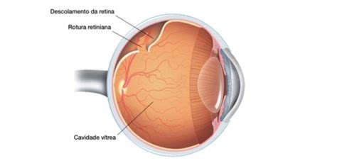 Descolamento De Retina Quais As Causas E Tratamentos