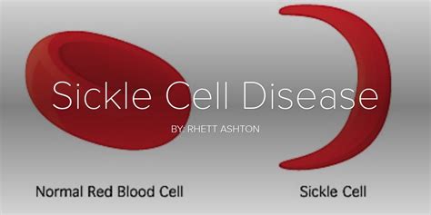 Sickle Cell Disease