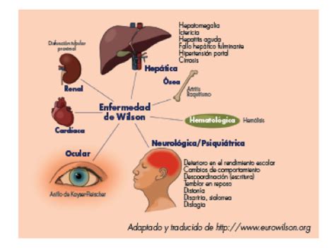 Asociación Enfermedad Wilson ENFERMEDAD DE WILSON