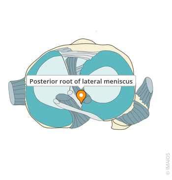 posterior root  lateral meniscus  anatomy imaios