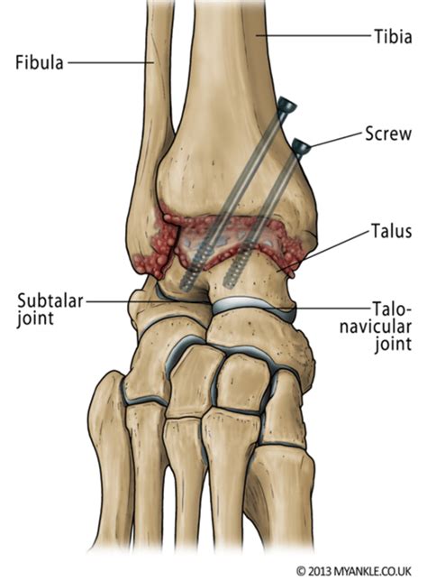 Ankle Fusion Surgery - Bunbury Foot & Ankle Surgeon