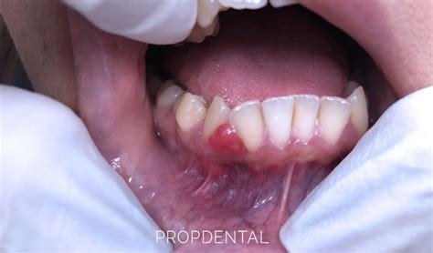 Granuloma Piogénico Dental Tratamiento Del Granuloma Piogénico