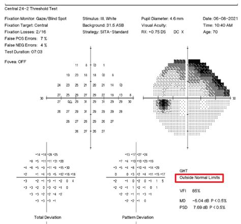 An Update on Standard Automated Perimetry - Glaucoma Today