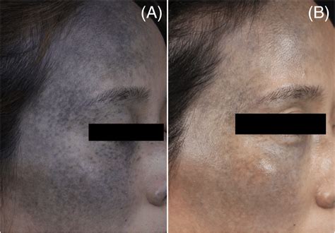years  female  nevus  ota    side   face