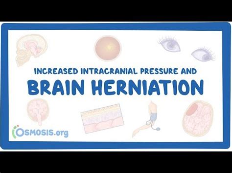 Brain herniation – causes, symptoms, diagnosis, treatment, pathology ...