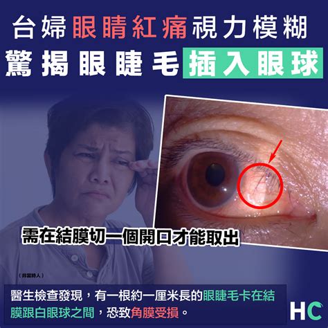 【揉眼睛】台婦眼睛又紅又痛視力模糊 驚揭眼睫毛插入眼球 Health Concept