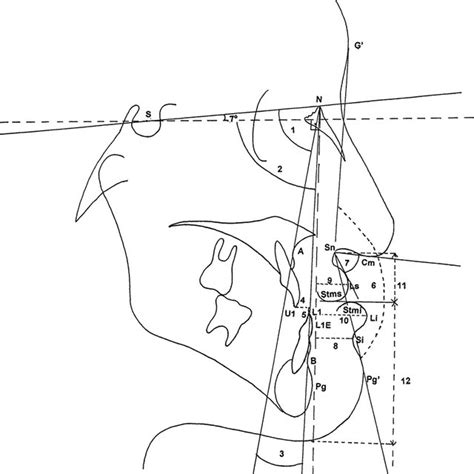 Hard And Soft Tissue Measurements 1 Sna Angle 2 Snb Angle 3 Anb Download Scientific