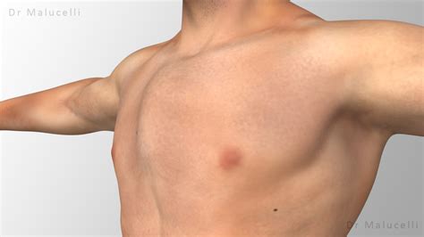 Como funciona a cirurgia de Pectus Carinatum? - Dr. Malucelli