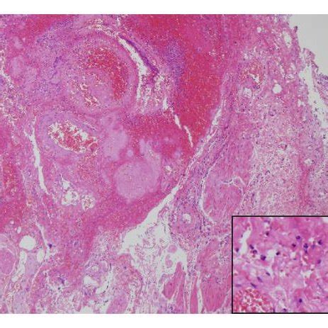 PDF A Case Of Severe Hemorrhagic Cystitis Caused By Melphalan With