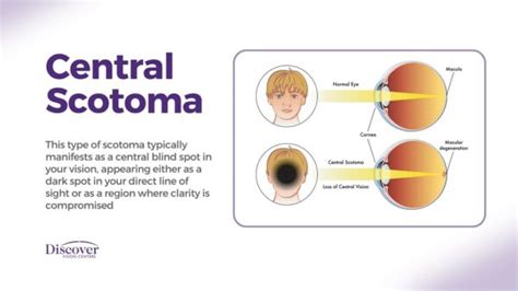 Scotoma: Blind Spot in Vision | Discover Vision