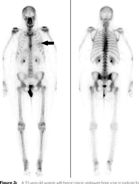 Figure 3 From Management Of Incidental Breast Lesions Detected At