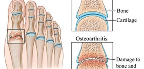 All About Arthritis – We Treat Feet