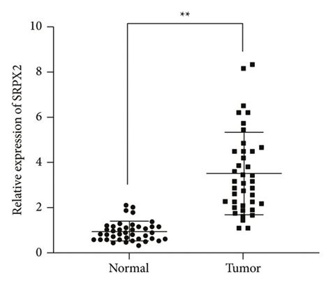 Srpx2 Is Elevated In Ptc A Srpx2 Expression In Ptc Cells B Srpx2 Download Scientific