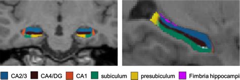 Automated Delineation Of The Hippocampal Subfields Left Coronal