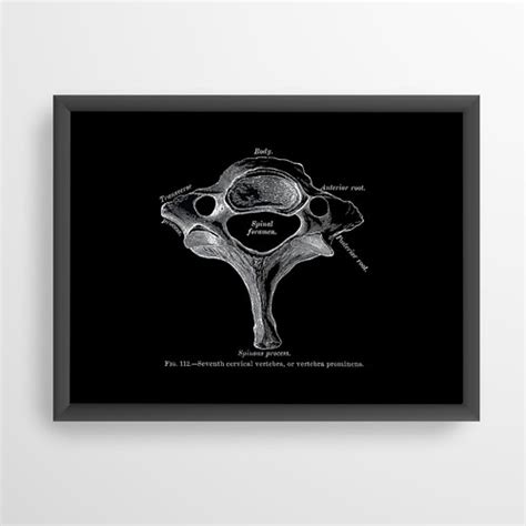 Vertebra Prominens Cervical Spine Vintage Human Anatomy Art Print X-Ray ...