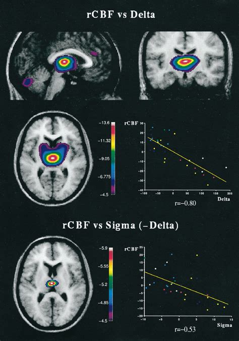 Normalized RCBF Decreases As A Function Of And Spindle EEG