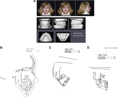 A B C And D Facial And Intraoral Post Treatment Records The Patient