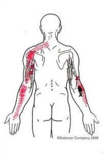 TRICEPS TEAR RECOVERY TIME 2 - Muscle Pull | Muscle Pull