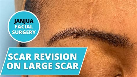 Scar Revision On Large Forehead Scar Dr Tanveer Janjua New Jersey