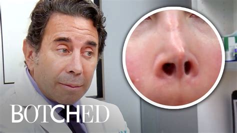 Most Amazing Nose Skin Surgeries From Dr Paul Nassif Botched E